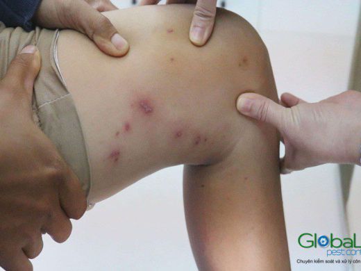Bed bug bites in a cluster on exposed skin